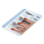 Magnet Flexible Structure de l'implant dentaire (Côté Gauche)