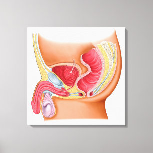 Medische illustratie van een recontrethrale fistel canvas afdruk