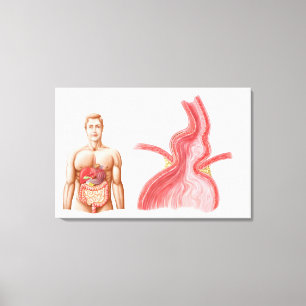 Medische isolatie van een Hiatale Hernia in de Canvas Afdruk