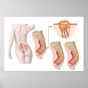 Medische isolatie van een proefcyclus poster