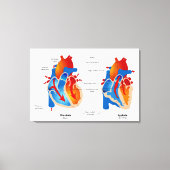Medische kaart met hartbloeding canvas afdruk (Voorkant)