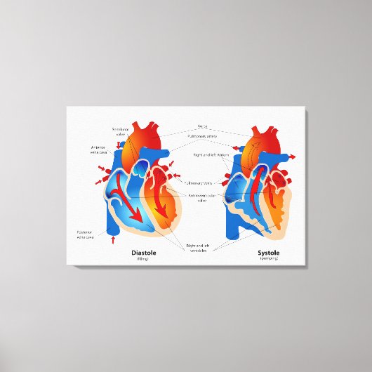 Medische kaart met hartbloeding canvas afdruk (Voorkant)
