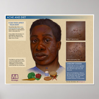 Melalogic Acne en Dieet Medisch Poster