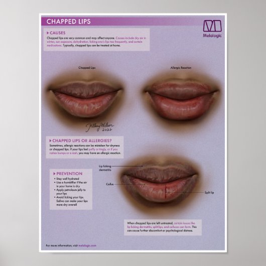 Melalogic Chapped Lips Medical Poster (Voorkant)