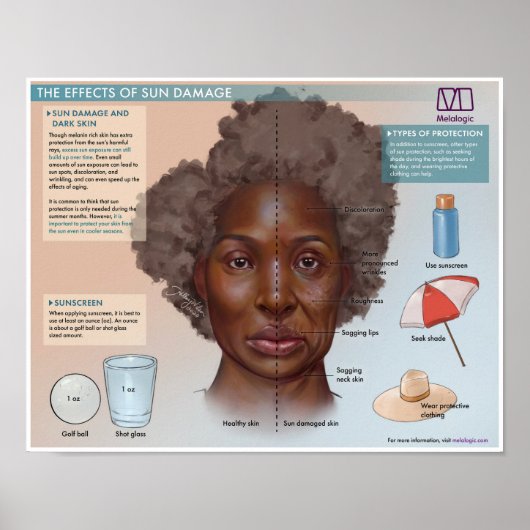 Melalogic De effecten van zonschade Medisch Poster (Voorkant)