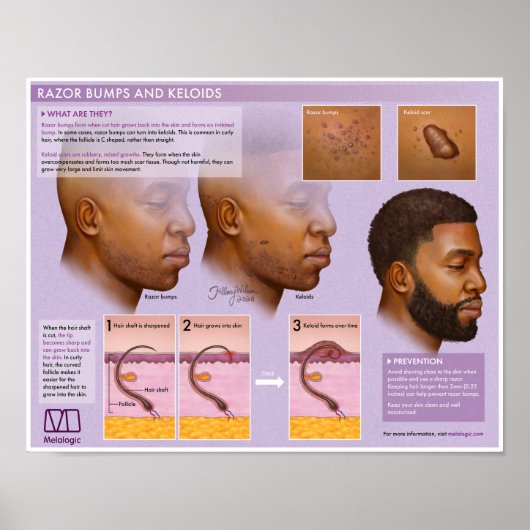 Melalogic Razor Bumps and Keloids Medical Poster (Voorkant)
