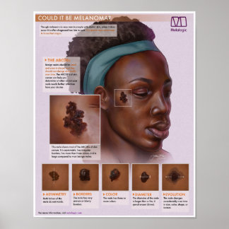 Melalogisch melanoom medisch Poster