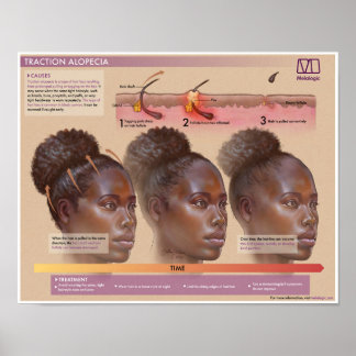 Melalogische tractie Alopecia Medisch Poster