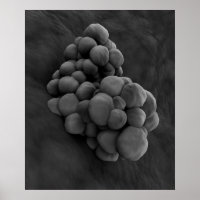 Microscopisch Uitzicht van tumor 1