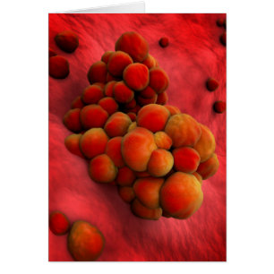 Microscopisch Uitzicht van tumor 2