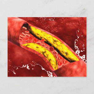 Microscopisch Uitzicht van vetplak in de slagader Briefkaart