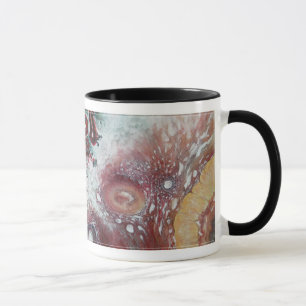 mok koffie! "Malignant Struma Ovarii"