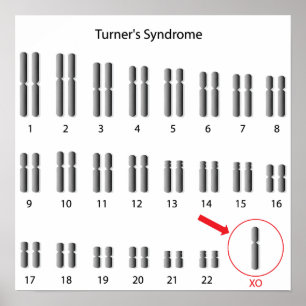 Monosomy X, Turner's syndrome Poster