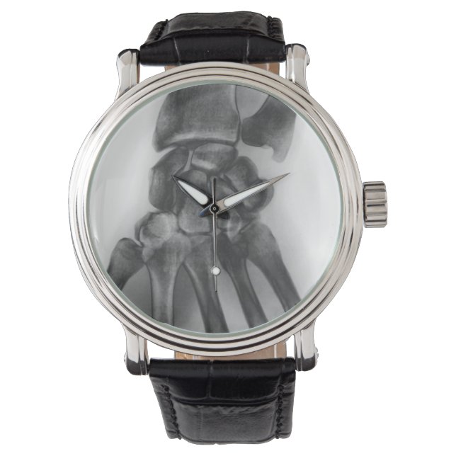 Montre Poignets normaux, rayons X (devant)