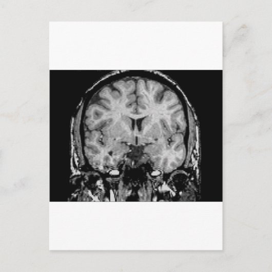 MRI voor hersenen, coronaal segment Briefkaart (Voorkant)