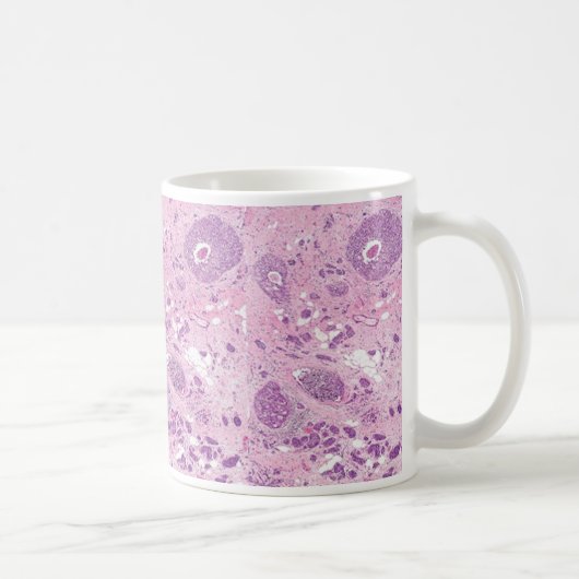 Mug Cellules cancéreuses de Tasse-Sein de café (Droite)