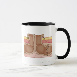 Mug Colostomie provisoire