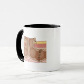 Mug Colostomie provisoire (Devant gauche)