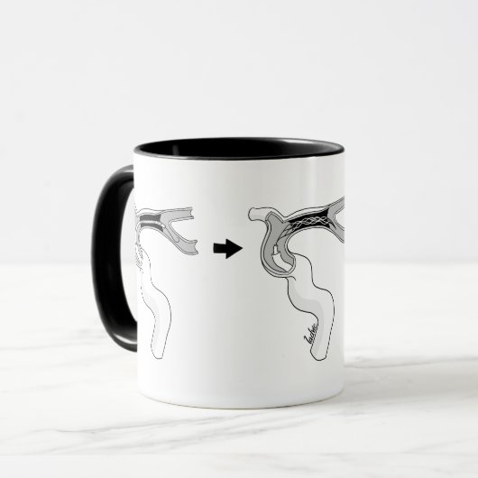 Mug de Trombectomía Mok (Voorkant links)
