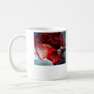 Mug Dissection aortique croissante