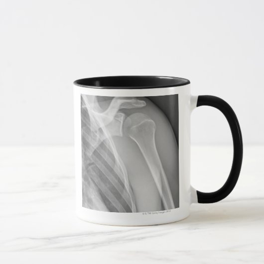 Mug Épaule normale. Rayon X de la gauche saine (Droite)
