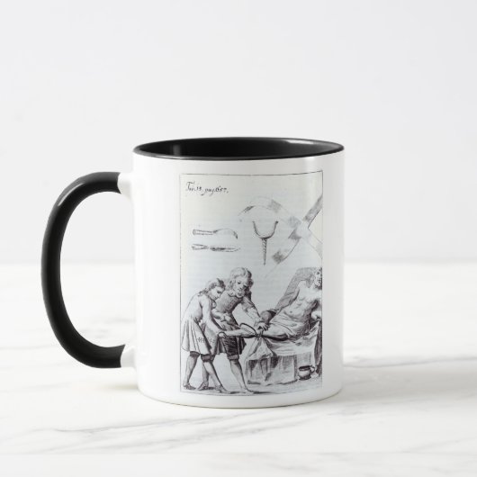 Mug Opération chirurgicale pour amputer une jambe (Gauche)