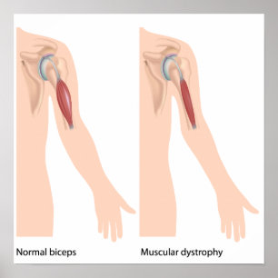 Musculair dystrofie Poster