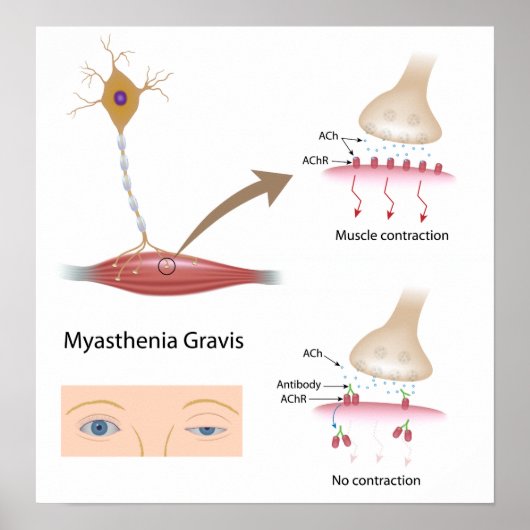 Myasthenia Gravis eye Poster (Voorkant)