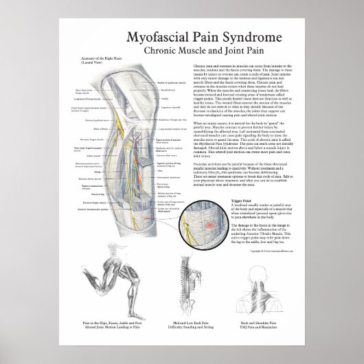Myofasciale pijn Syndroom Poster (Voorkant)