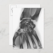 Normale pols, röntgenstraal briefkaart (Voorkant / Achterkant)