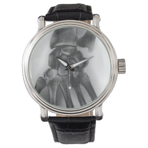 Normale pols, röntgenstraal horloge