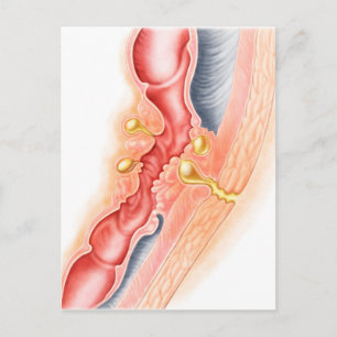 Ontwikkeling van fistels briefkaart