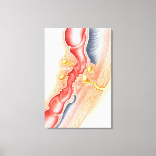 Ontwikkeling van fistels canvas afdruk