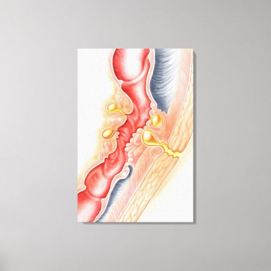 Ontwikkeling van fistels canvas afdruk (Voorkant)