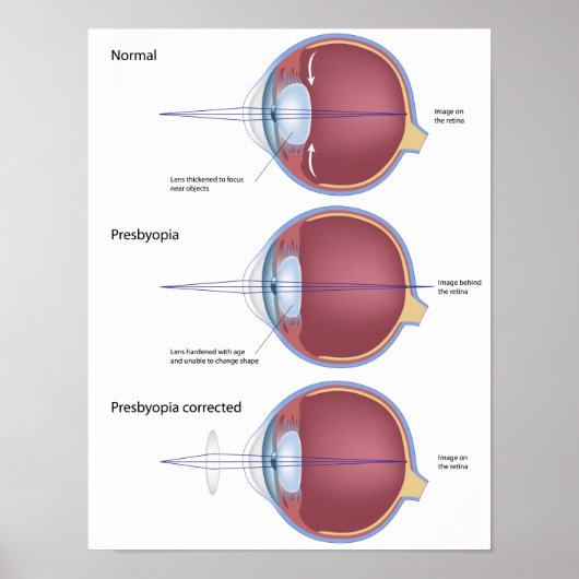 Oogdefect presbyopia Poster (Voorkant)