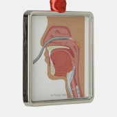 Ornement Carré Argenté Endoscopie du nez (Droite)