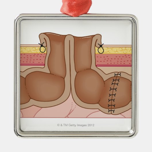 Ornement Métallique Colostomie provisoire (Devant)