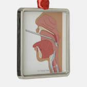 Ornement Métallique Laryngoscopie de miroir (Droite)