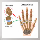 Osteoartritis van het hand Poster (Voorkant)