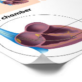 Pacemaker insertion surgery Poster (Coin)