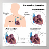 Pacemaker insertion surgery Poster (Devant)