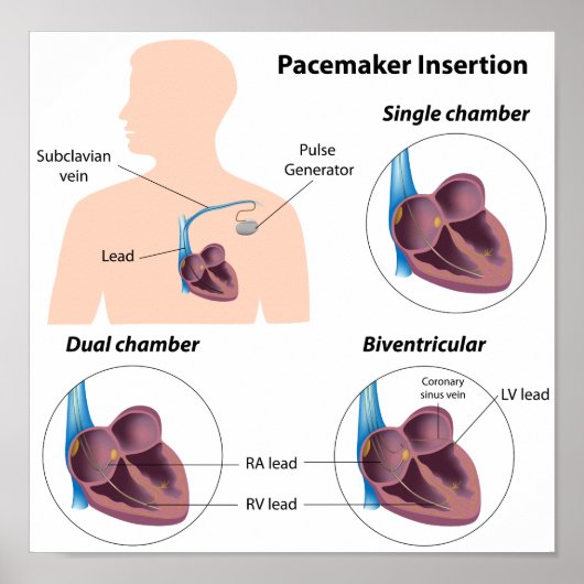 Pacemaker insertion surgery Poster (Devant)
