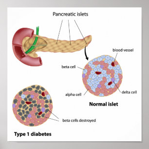 Pancreaseiland en Poster van diabetes