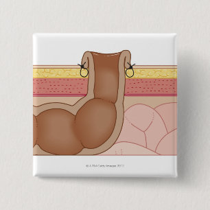 Permanent Colostomy Vierkante Button 5,1 Cm