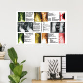 Phases Cervical Lumbar Spinal Degeneration Poster (Thuiskantoor)