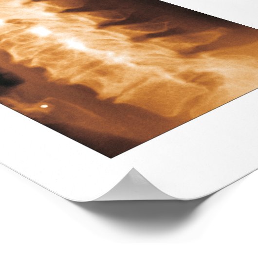 Phases Cervical Spinal Degenering Poster (Coin)