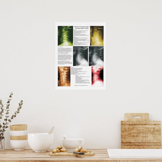 Phases Cervical Spinal Degenering Poster (Cuisine)
