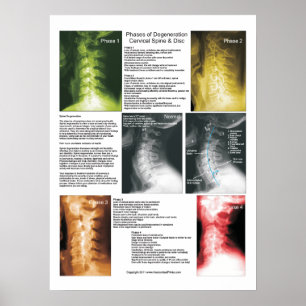 Phases Cervical Spinal Degenering Poster
