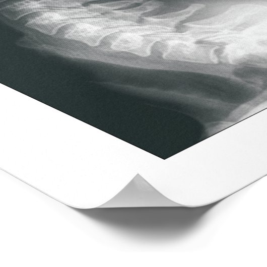 Phases Cervical Spinal Degenering Poster (Coin)