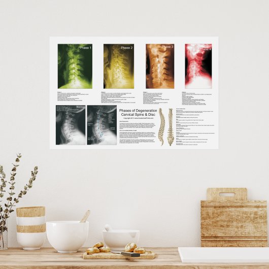 Phases Cervical Spinal Degenering Poster (Cuisine)